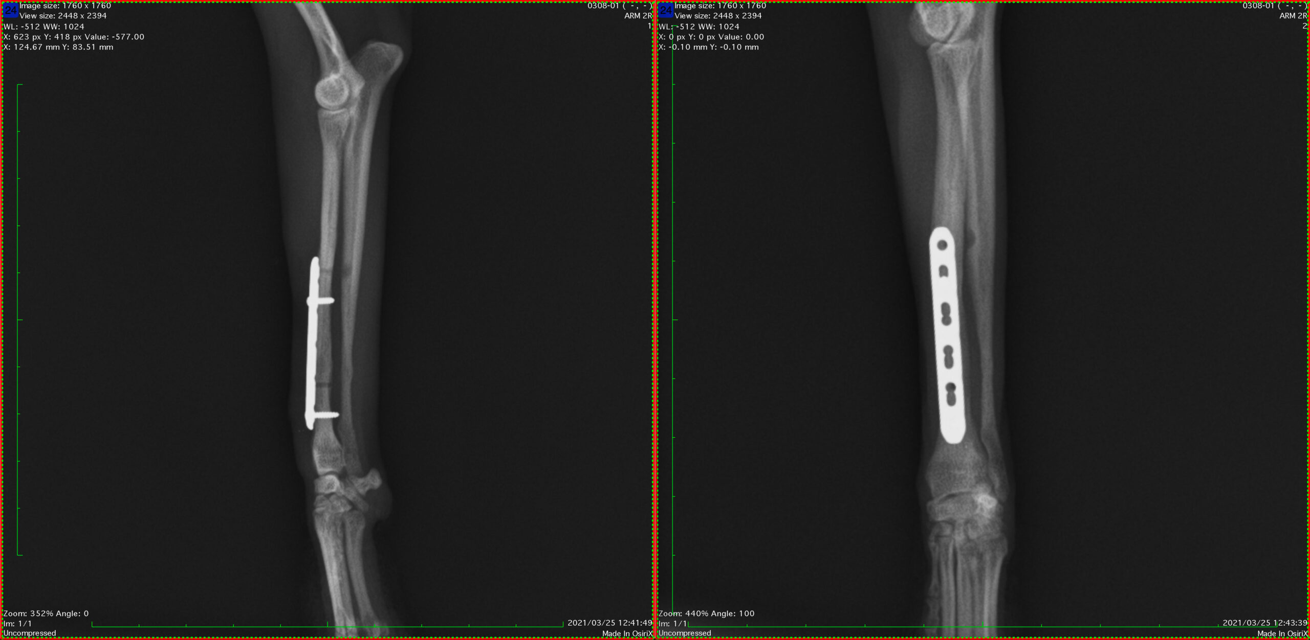 4.抜スクリュー直後
