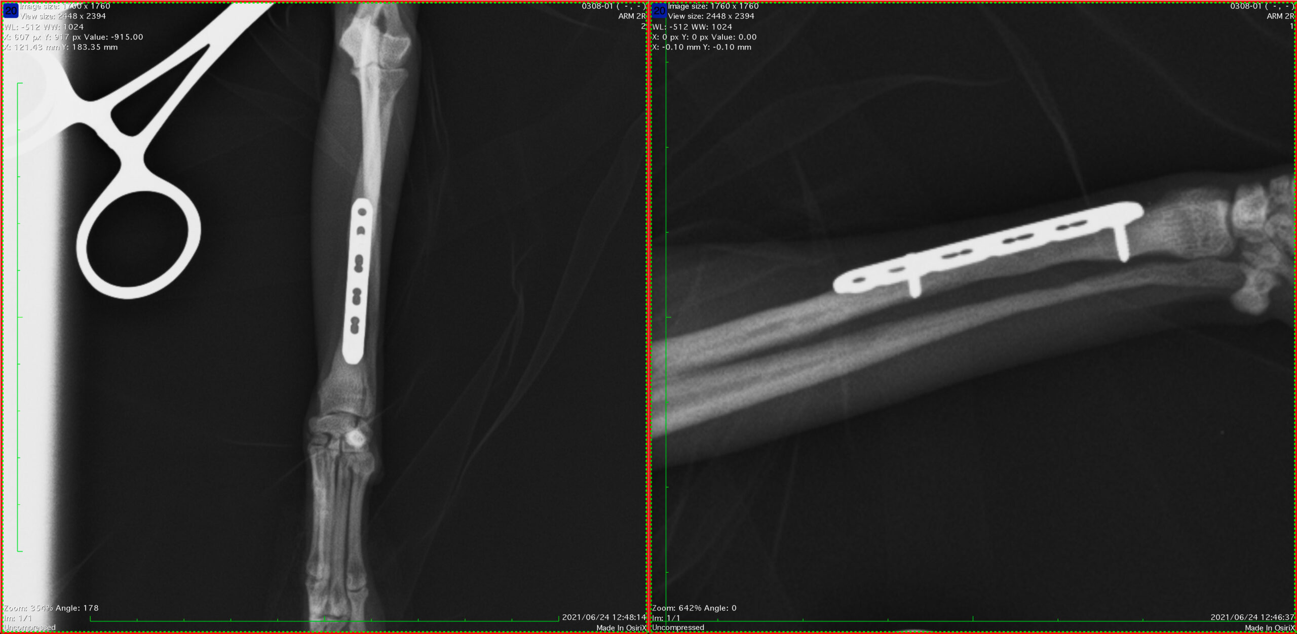 5.抜プレート直前